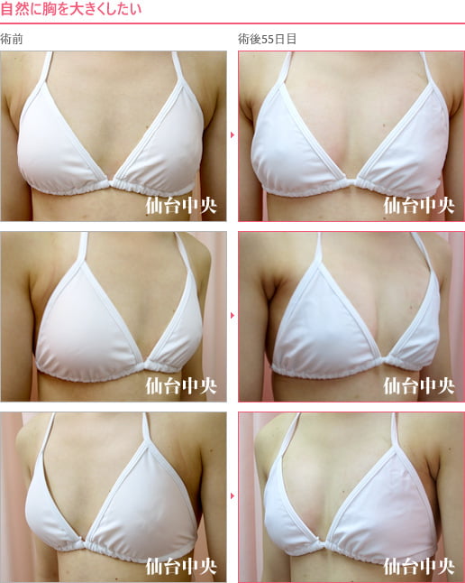 自然に胸を大きくしたい 症例写真1