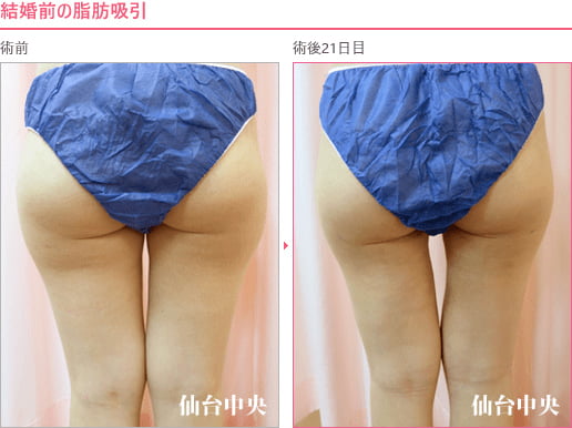 結婚前の脂肪吸引 症例写真