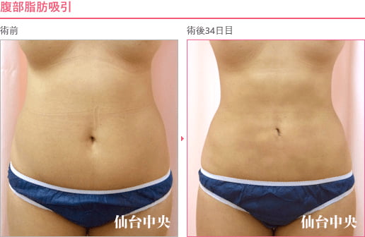 腹部脂肪吸引 症例写真