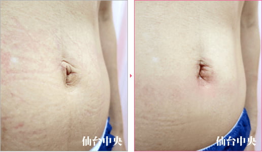 臍の整形 症例写真2