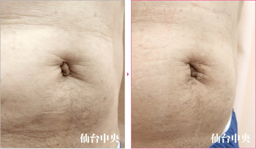 出べそ修正 症例写真2