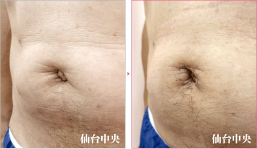 出べそ修正 症例写真3